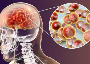 La meningitis produce una inflamación de los tejidos que rodean el cerebro. Foto: RRSS.