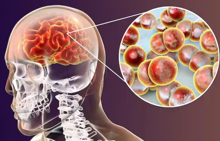 La meningitis produce una inflamación de los tejidos que rodean el cerebro. Foto: RRSS.