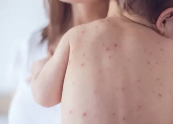 Un bebé menor de un año dio positivo a sarampión en Santa Cruz. Foto: Ministerio de Salud.