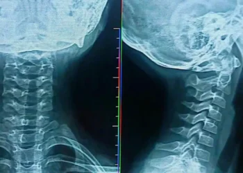 Los ligamentos del cuello fueron dañados
