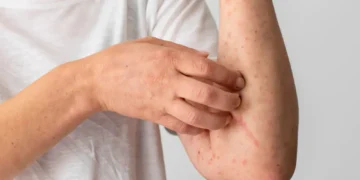 varicela