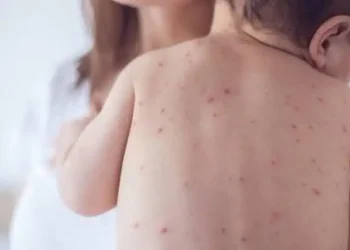 sarampión
