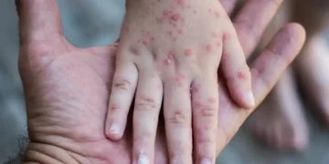 Una niña con sarampión. Foto referencial (RRSS)