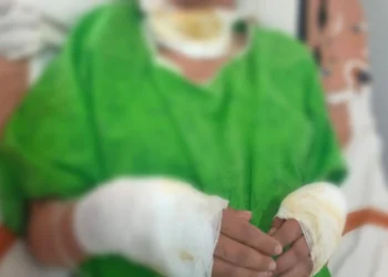 La adolescente atacada por sus padres tiene quemaduras de primer y segundo grado. FOTO: Fiscalía de Oruro